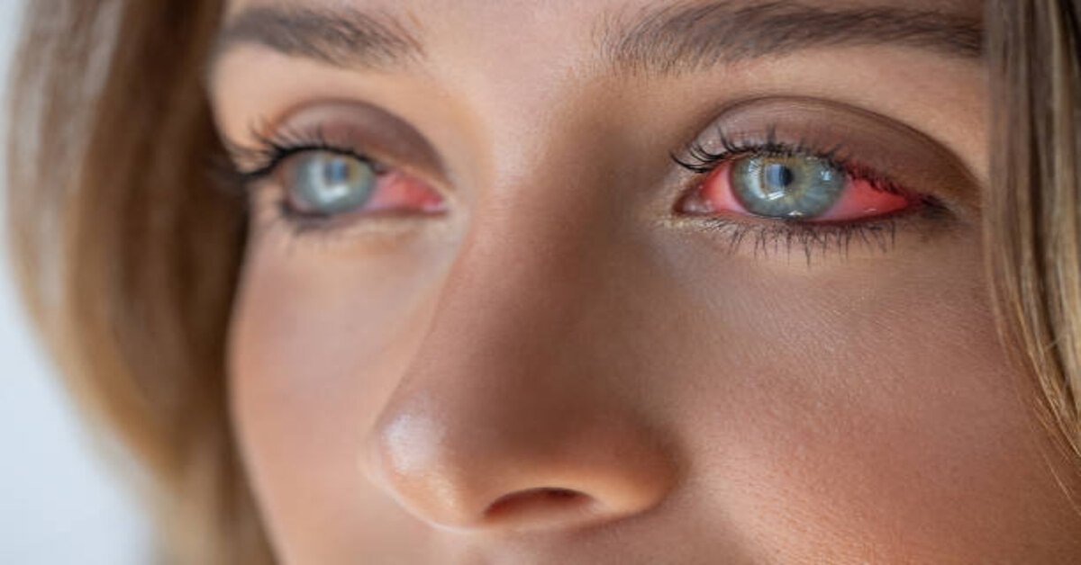 Read more about the article How Can Contacts Cause Red Eyes?