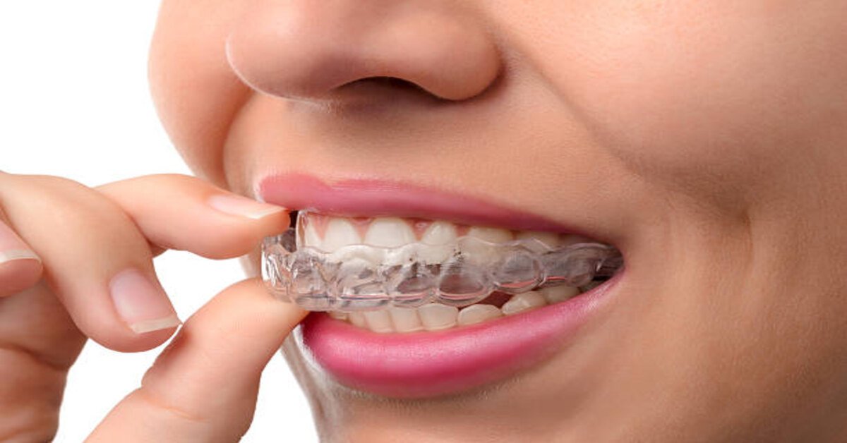 Read more about the article 7 Types of Teeth Aligners