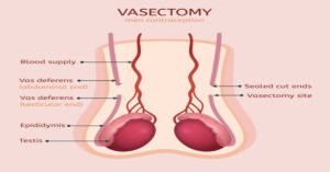 Read more about the article FAQ About Vasectomy Recovery