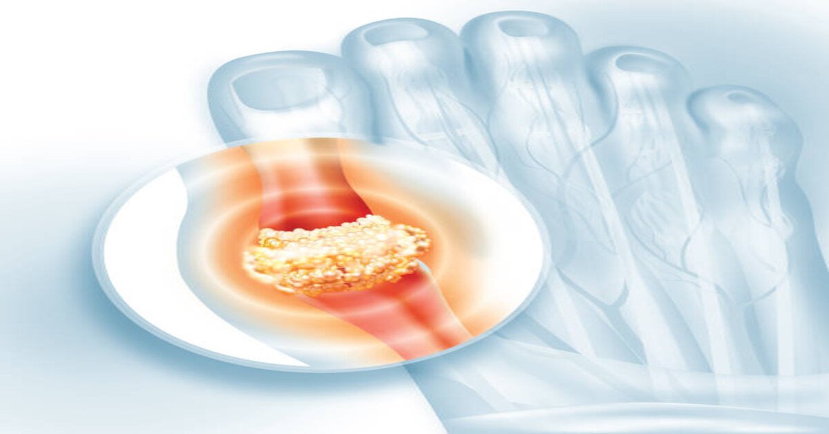 Read more about the article Understanding Bunions: Causes, Symptoms, and Treatment Options  